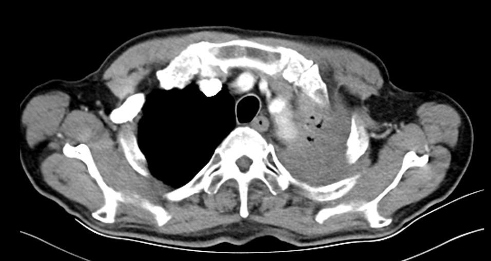驱动基因阳性早期肺腺癌生存期,肺鳞癌驱动基因阳性比例