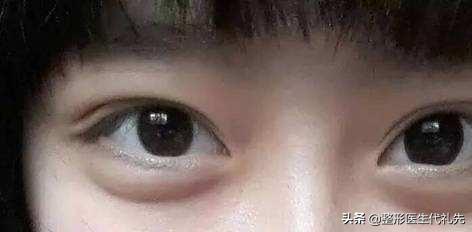 眼轮匝肌肥厚型眼袋去除的价格,眼轮匝肌肥厚而造成的眼袋突出