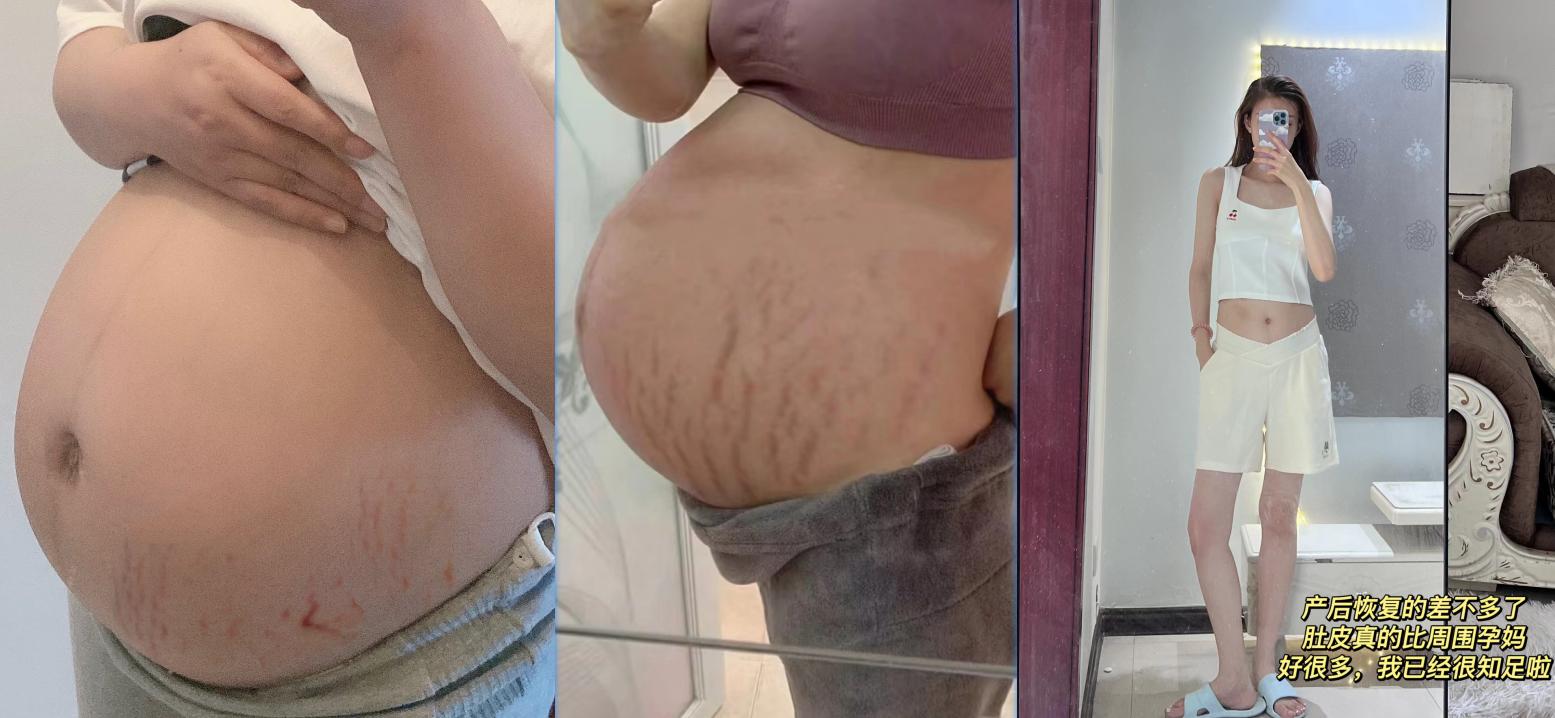 怀孕期间淡化妊娠纹的产品推荐,妊娠纹有没有好用有效果的产品