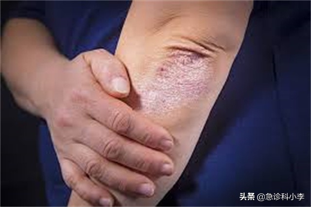 5种常见的疾病目前无法根治，千万别被忽悠了