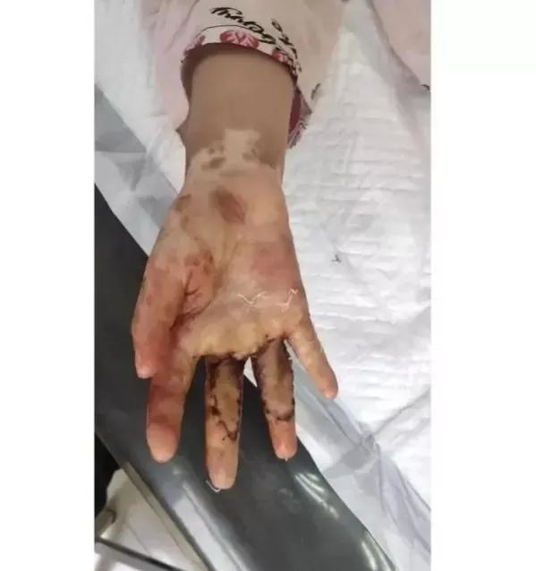 后妈狠心用烟头弄孩子手上痛哭,后妈疑把女童双手按进热水锅致残