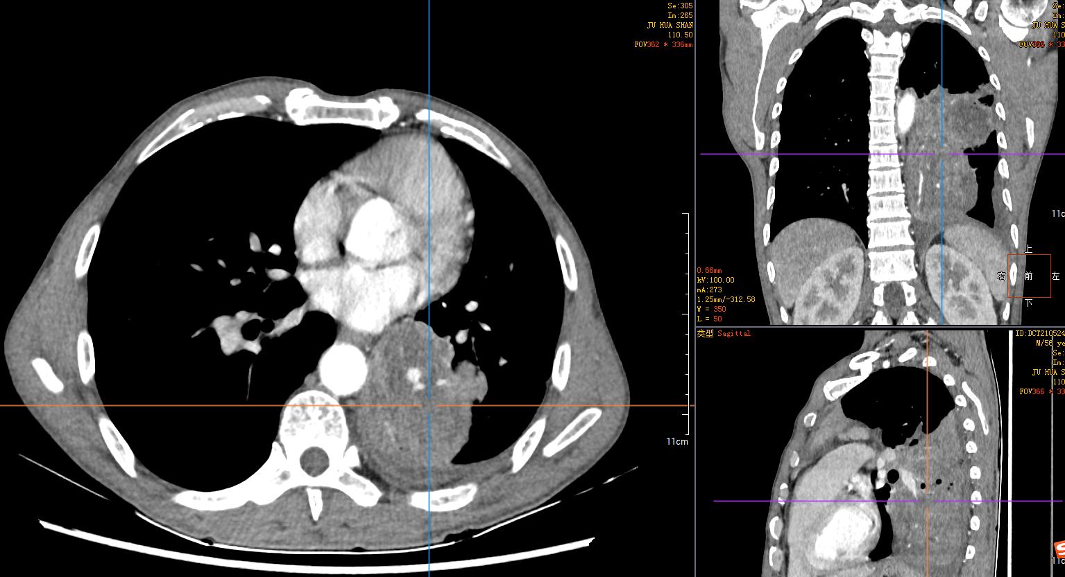 免疫治疗6次后肿瘤消失了,肺鳞癌中晚期化疗联合免疫治疗