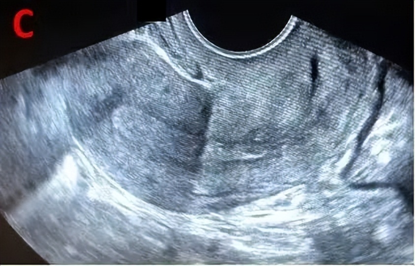 b超监测排卵显示不清是怎么回事,助孕好孕