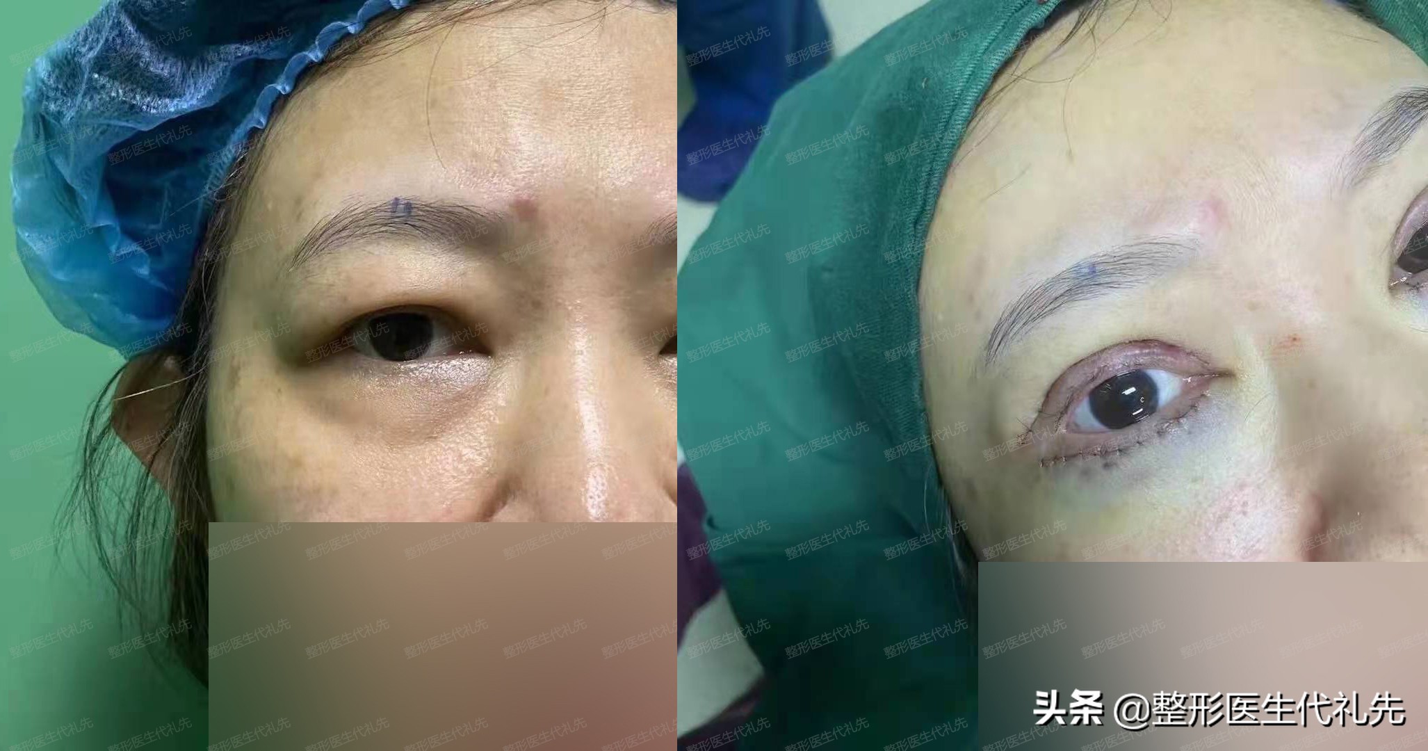 肿泡眼可以抽脂吗,有双眼皮是肿泡眼可以抽脂吗