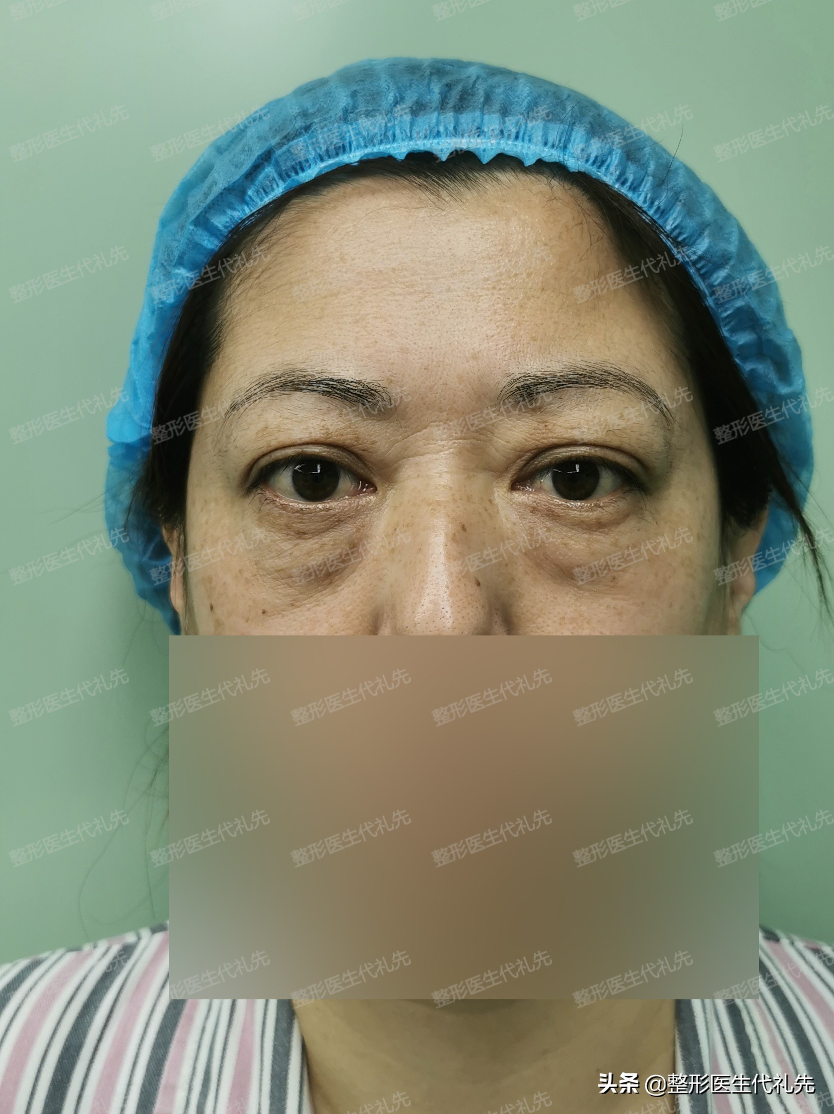 提眉外切眼袋7天后能化妆吗,提眉手术后多久可以做全切眼袋