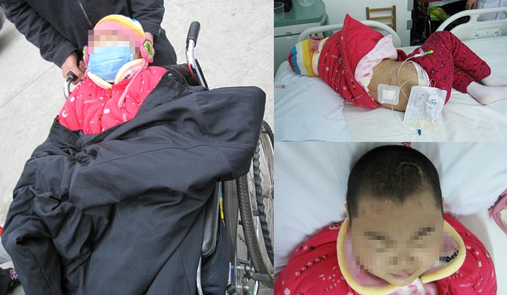 儿童结核脑膜炎脑积水,结核性脑膜炎脑积水如何引起