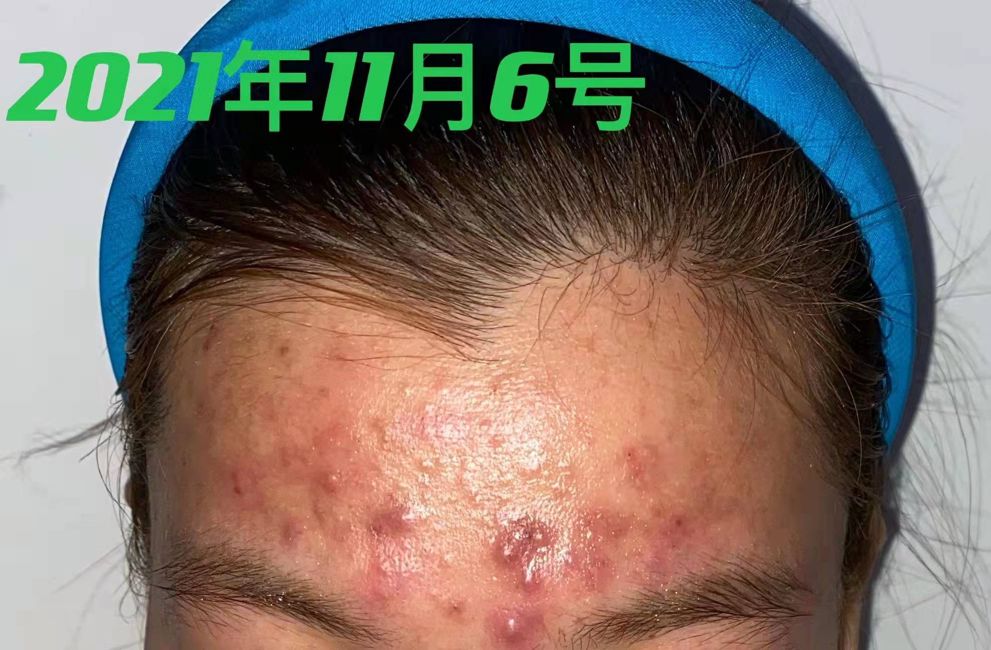 28岁女脸上反复长痘怎么办,28岁痘痘反复长是什么原因