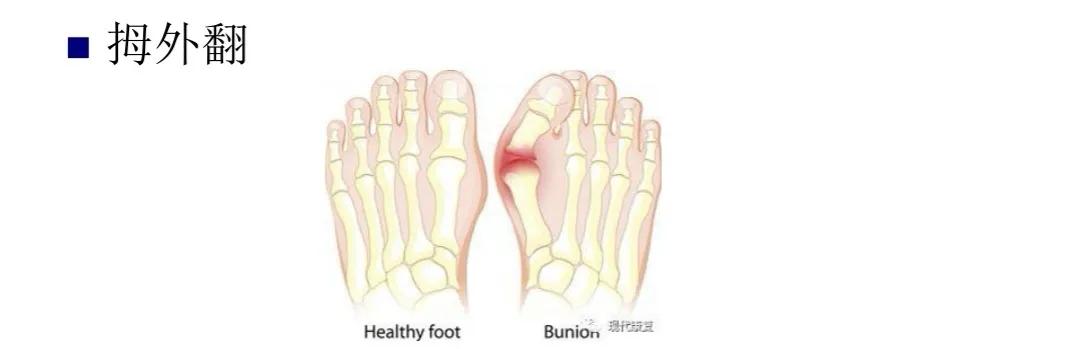 扁平足发病机制,扁平足诊断标准示意图