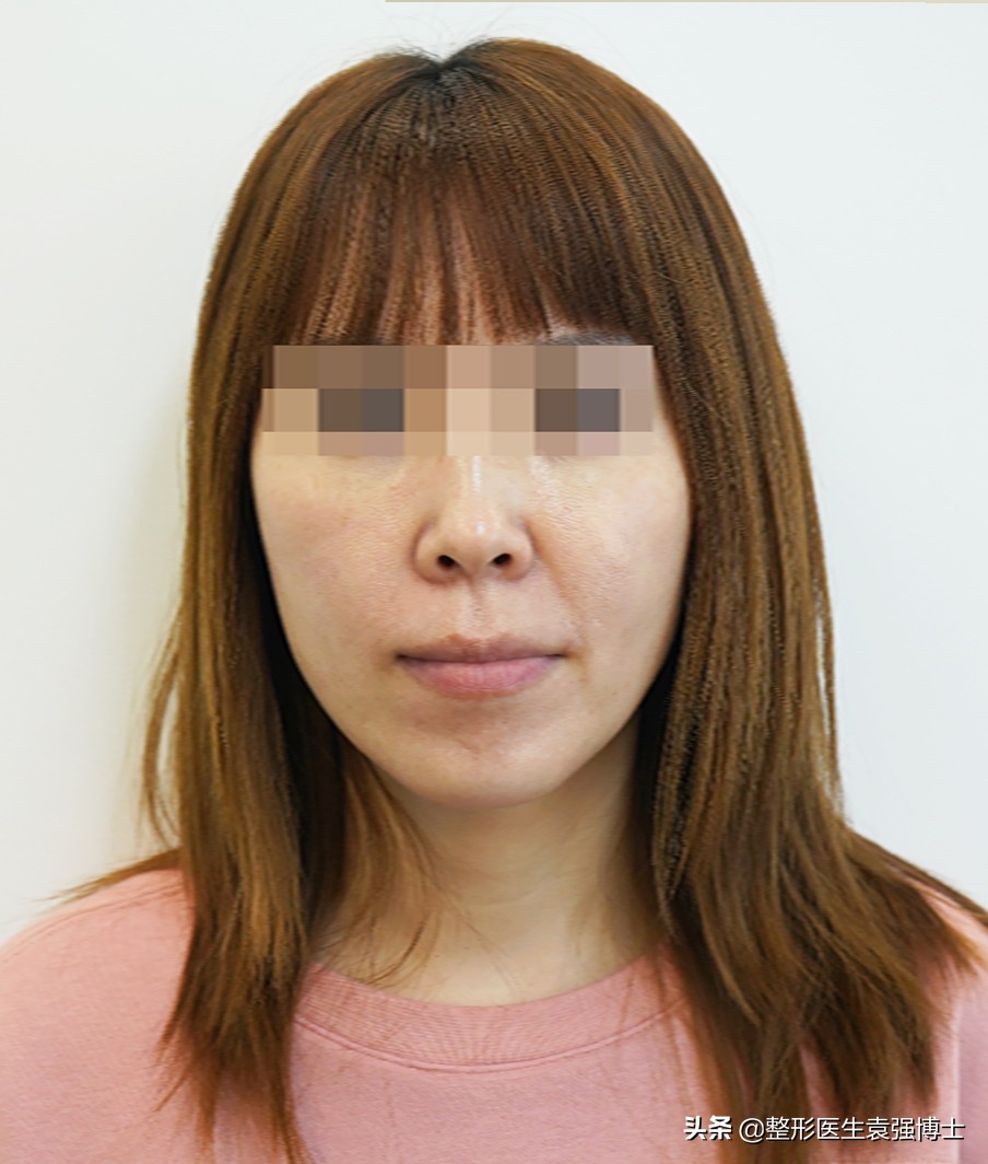 拉皮术后无美颜对比图,40岁拉皮术后恢复视频