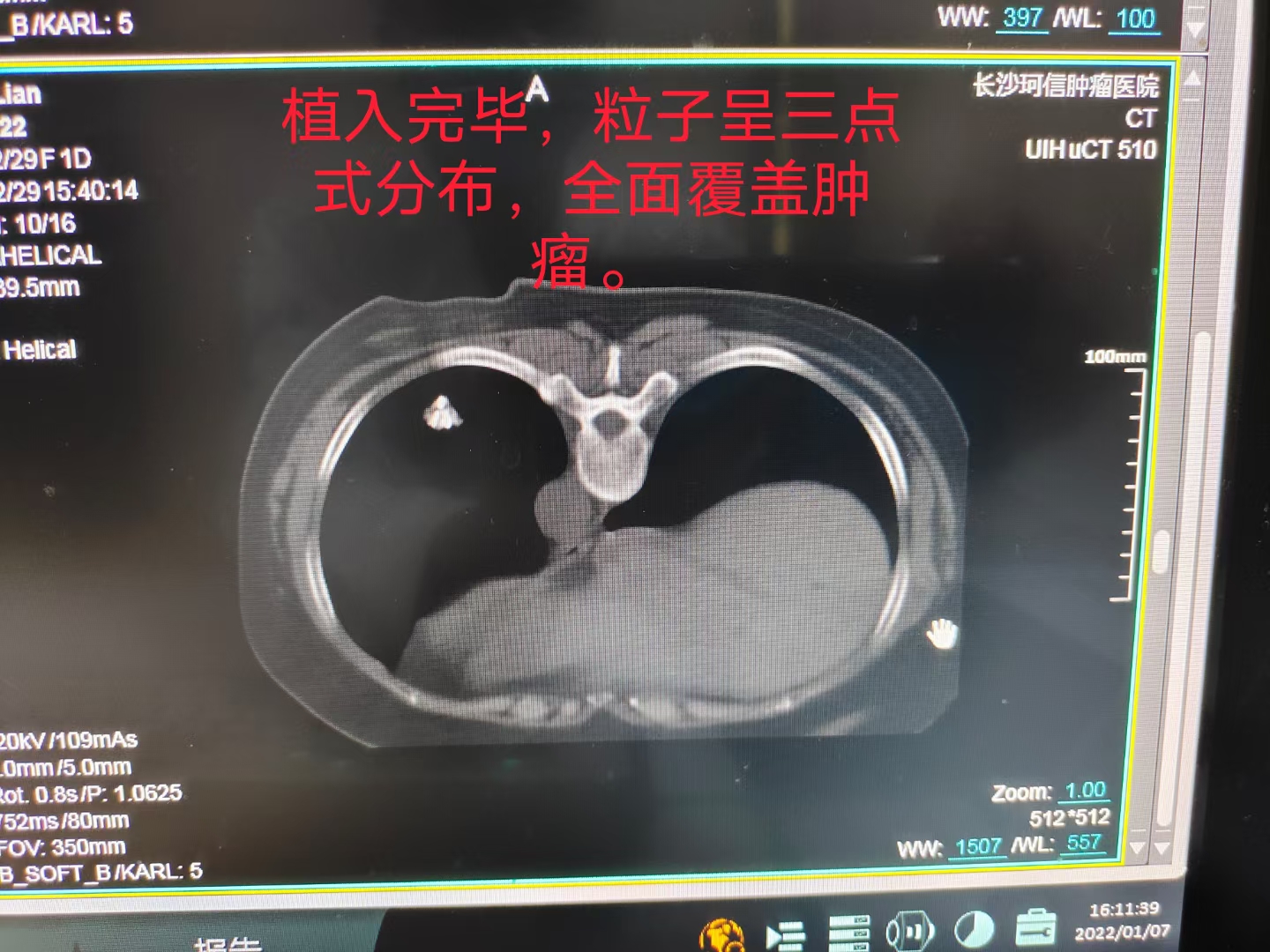 11厘米肺癌肿瘤粒子植入,肺癌多处转移放射治疗全过程