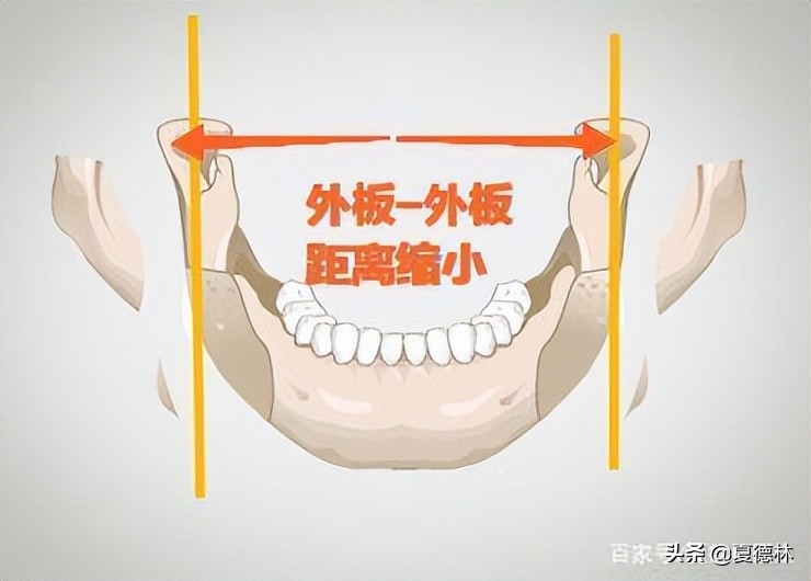 削骨和磨骨区别后遗症,削骨和磨骨的区别和危害