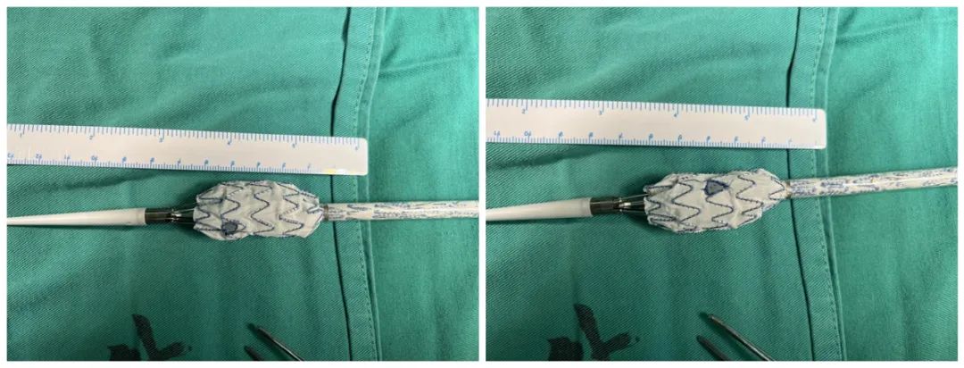 医学专家巧变“工艺师”，妙手缝制支架成功拆除主动脉“*弹炸**”