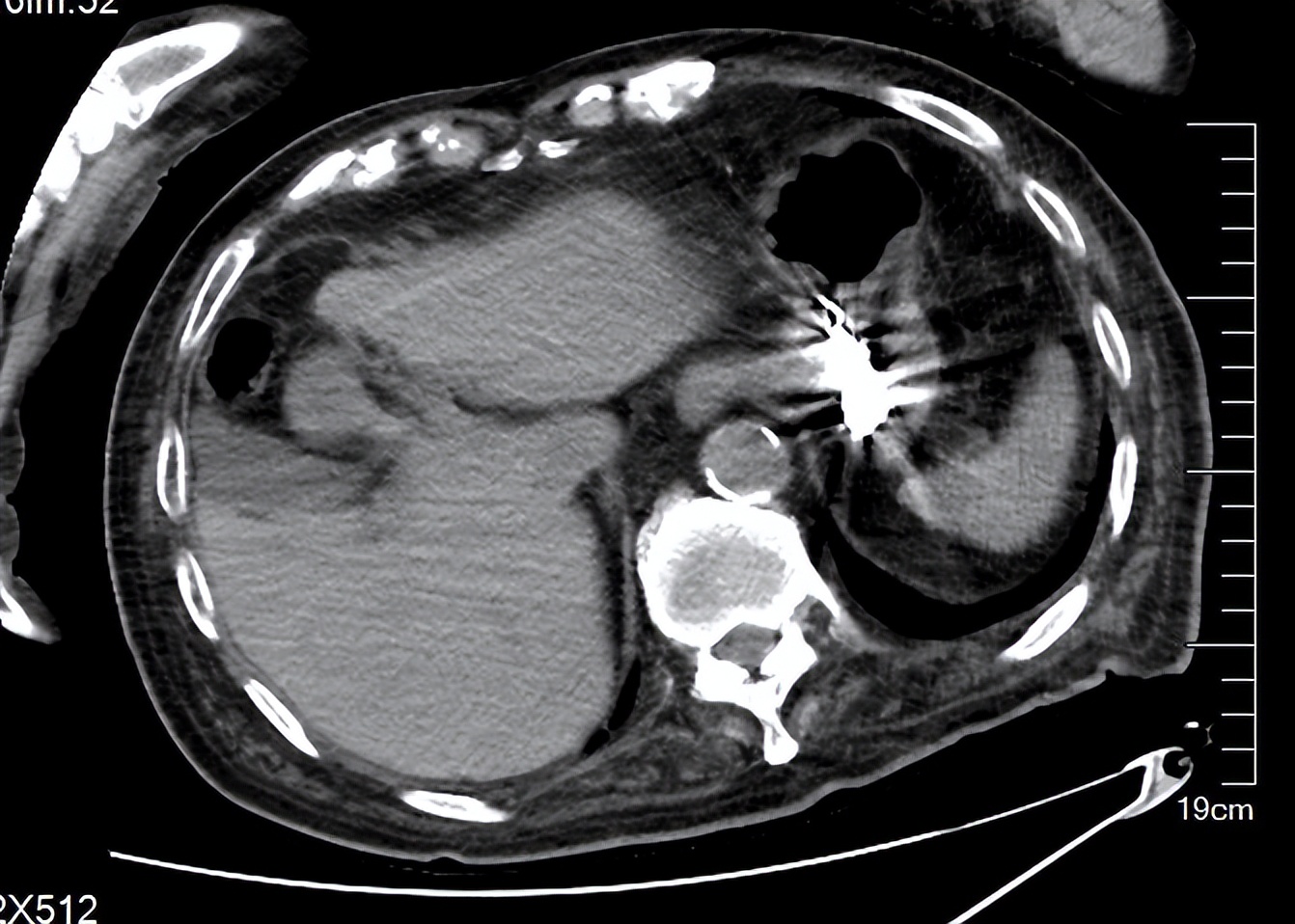 89岁老人吃饭突然不“香”了，原来是假牙吞进肚子里