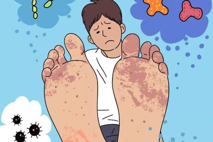 脚气痛痒难耐一个小妙招轻松解决,脚气痒得很怎么解决