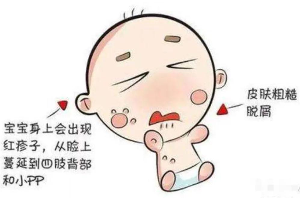 湿疹忌口会影响母乳质量吗,婴儿脸上长湿疹母乳应忌口什么