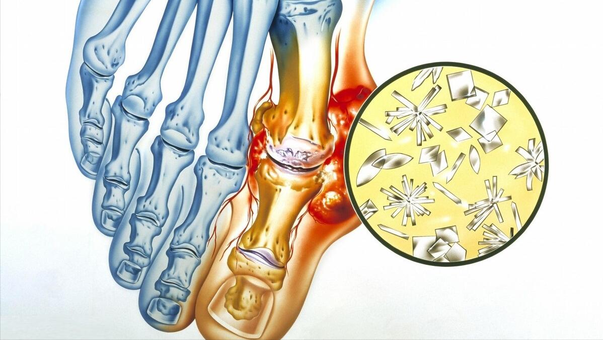 甲沟炎如何快速拔出脚趾甲,脚趾甲老往肉里钻一碰还疼