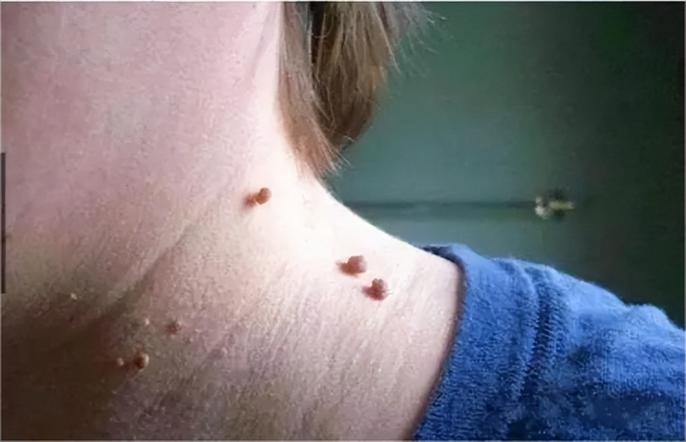 脖子上长很多丝状小肉球怎么办？医生：教你根除丝状疣和皮赘方法