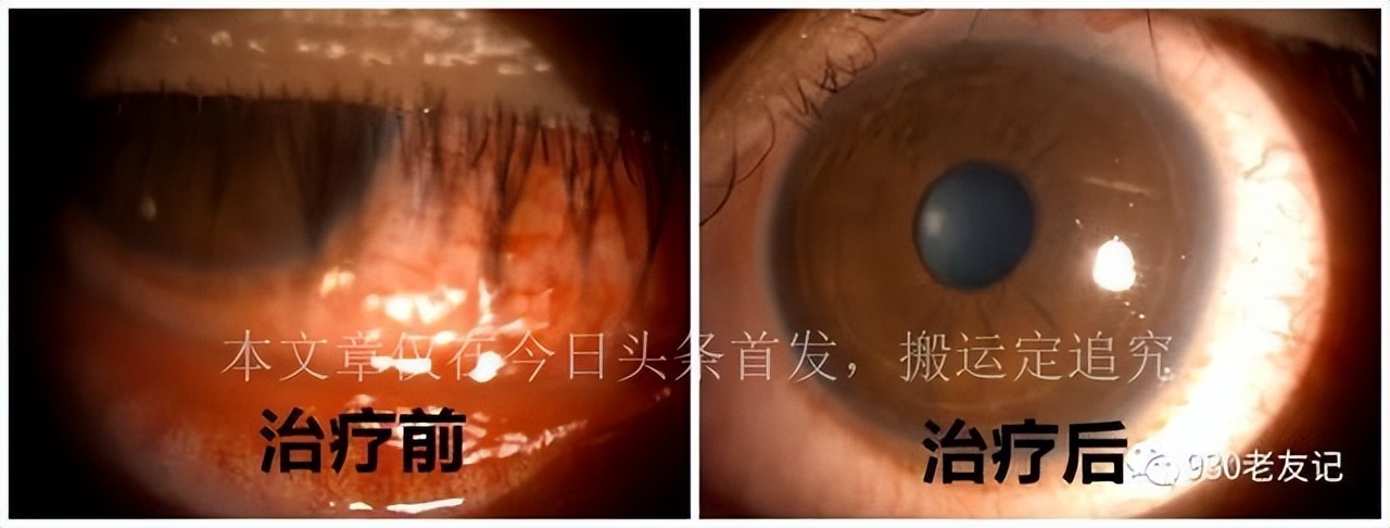 南宁小伙用酒店毛巾患上淋病,南宁男子患淋病