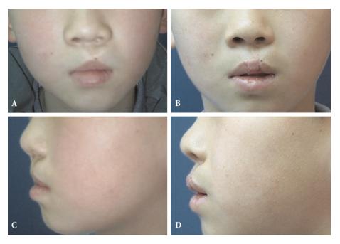 唇裂继发畸形修复全国哪家最好,宝宝唇裂畸形的手术修复费用