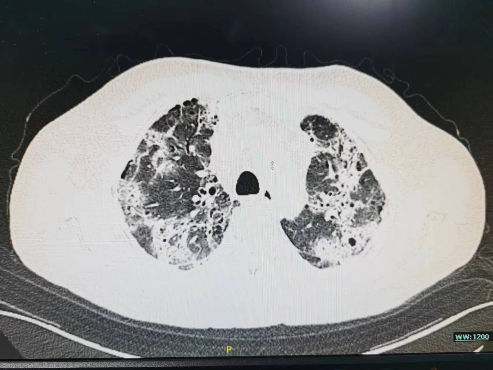老年人总是低热是怎么回事,老年人一直低热都有什么原因