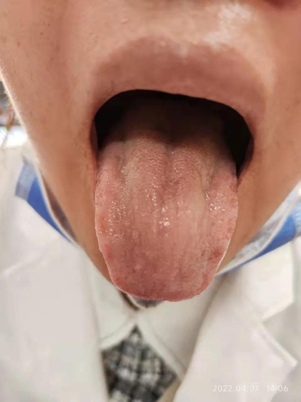 针药并用对发热的治疗效果如何,针药并用好处