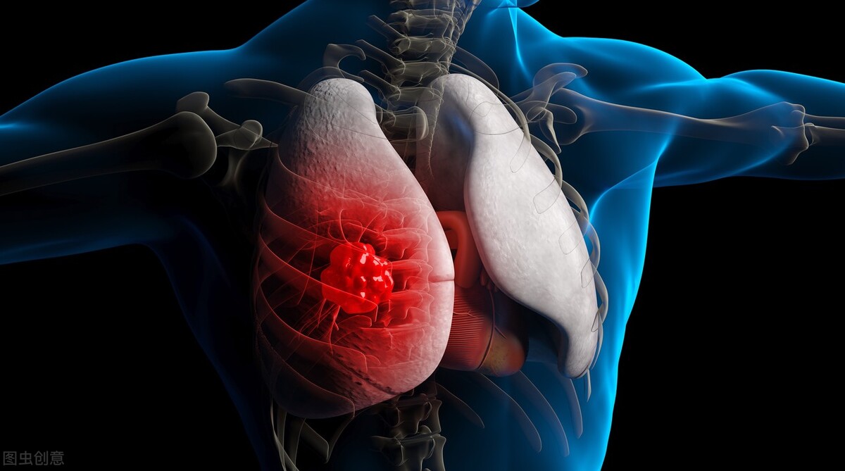 脖子淋巴结有个疙瘩是肺癌转移吗,女性颈部有个包块