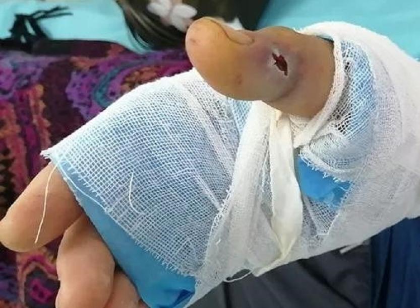 捡到眼镜蛇炖汤，剪掉的蛇头却突然“复活”，浙江老伯差点失明