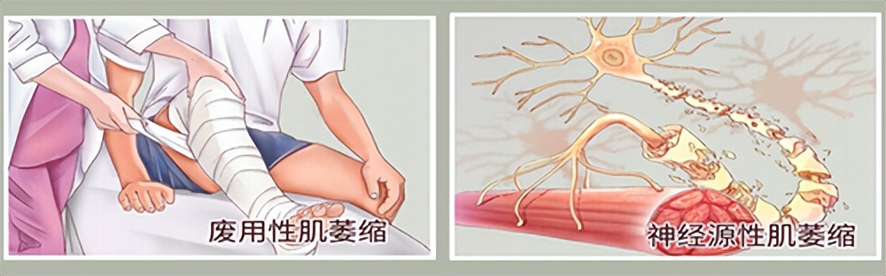 肌肉萎缩什么症状医问医答,罕见病肌肉萎缩症的症状是什么