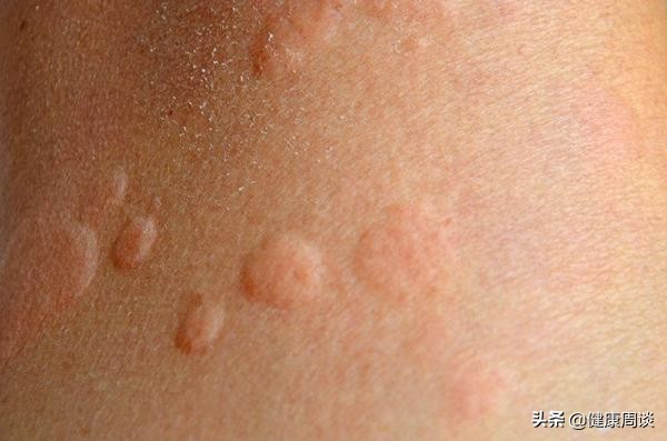 皮肤越挠越痒要什么药膏,皮肤总是越挠越痒是怎么回事