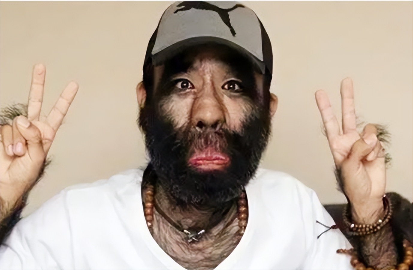 当年轰动一时的“毛孩”：42岁娶90后娇妻，生下一子未遗传长毛