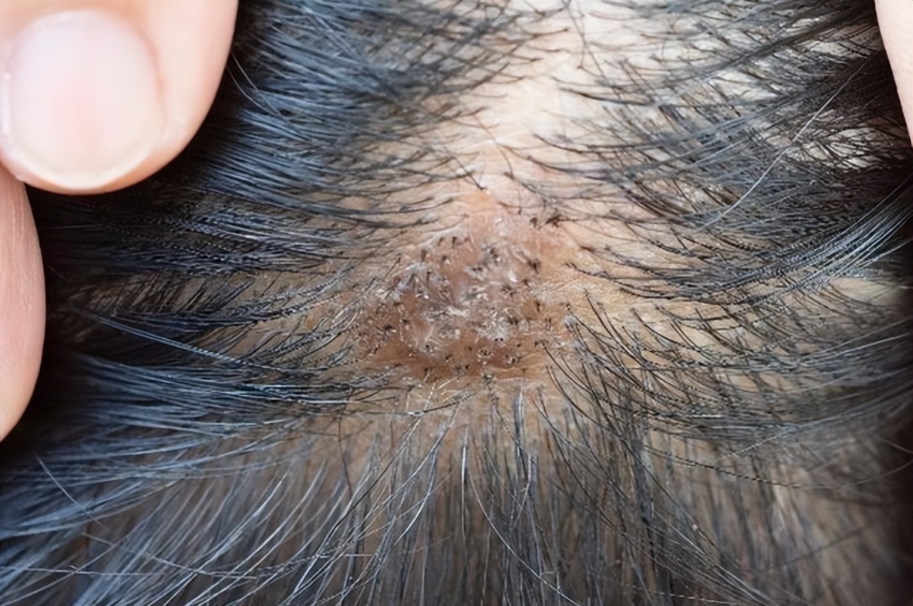为啥头皮总长“脓包”和“疙瘩”？提示：或与这4点有关