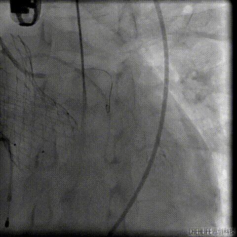 病例回顾与分享,腹膜后血肿介入治疗