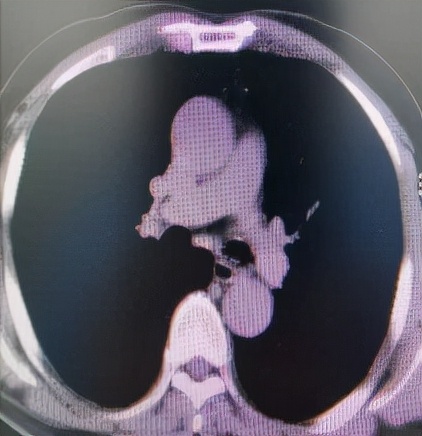 哈医大一院气管镜,哈医大群力呼吸内科