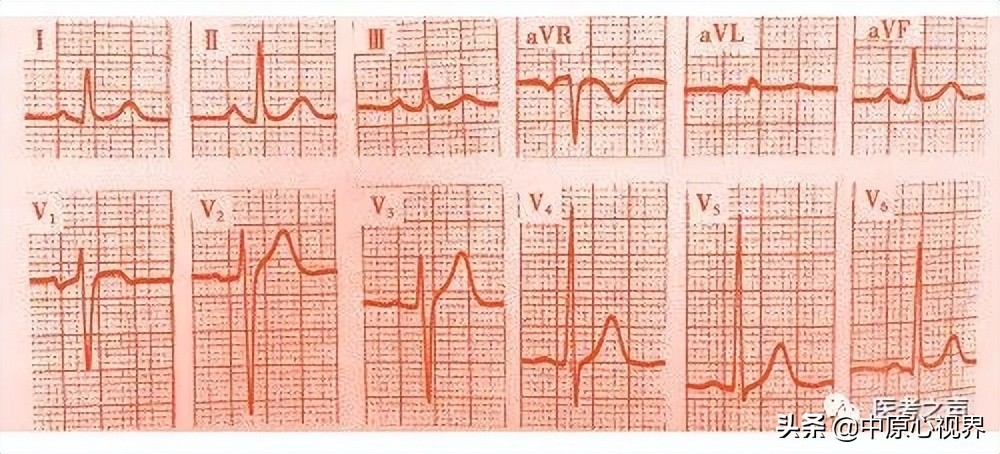 护考几种常见的心电图,常见的心电图图形分析