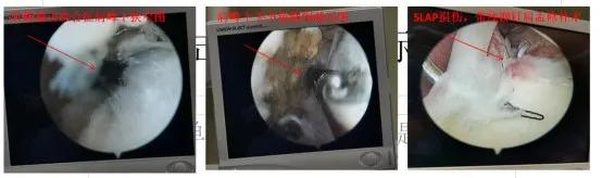 老是肩膀难受咋回事,肩膀痛要怎么缓解