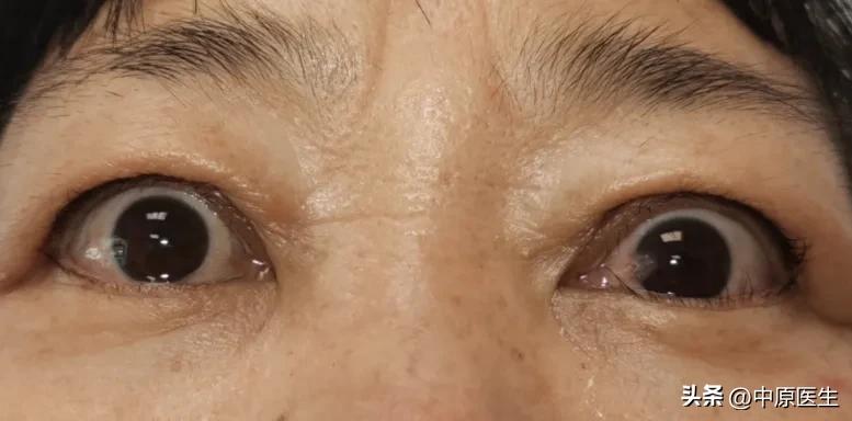 眼睛大眼球突出怎么治疗,眼睛很大眼球凸出是什么病