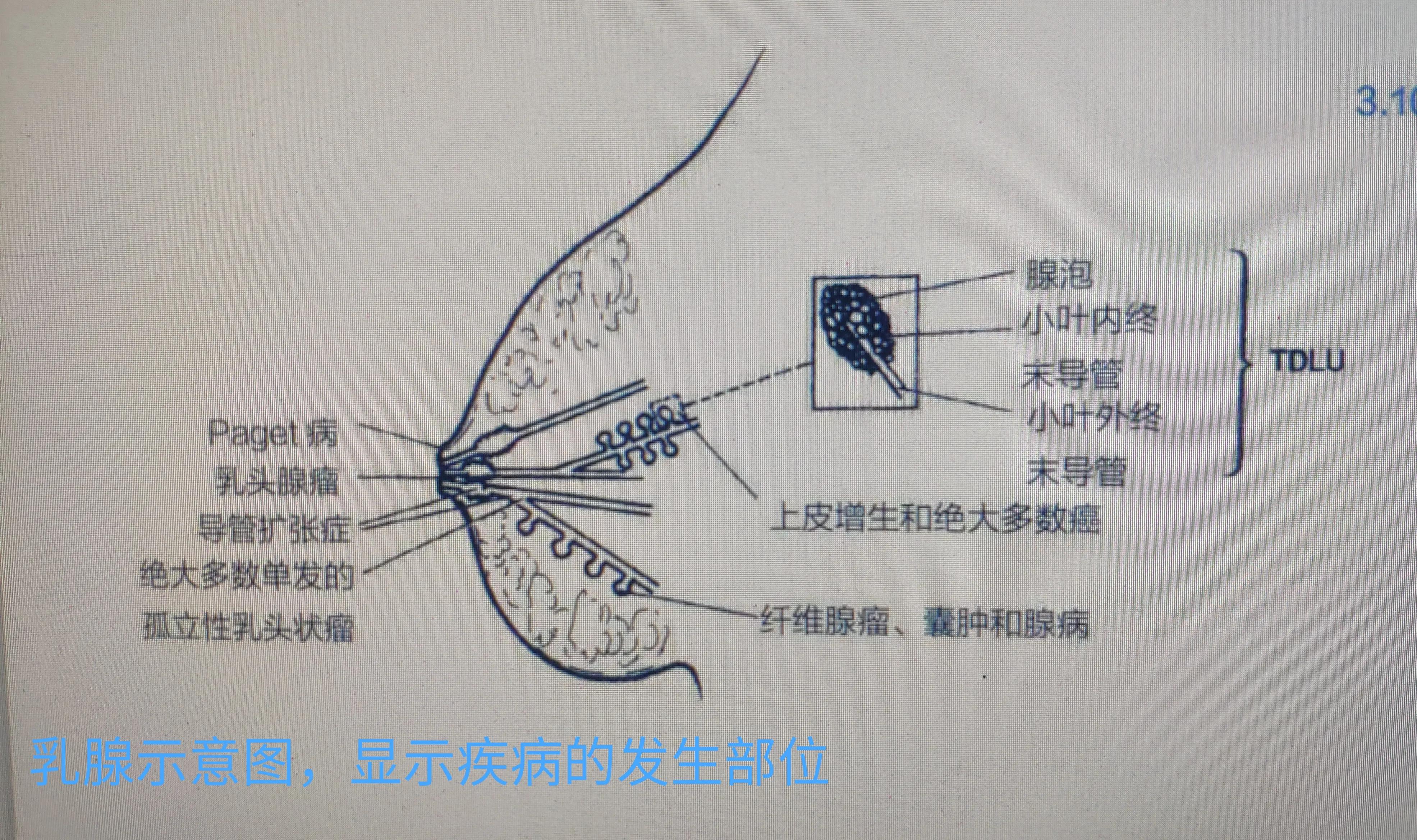 除了乳腺癌胸部还可能会得什么病,乳腺导管内病变不除外4a严重吗