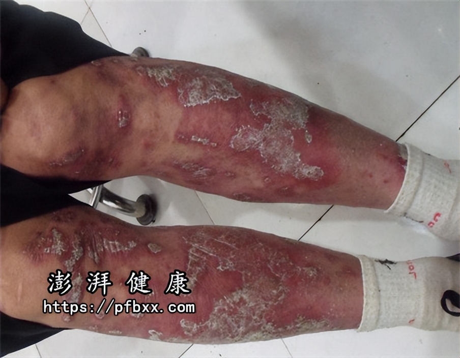 银屑病关节炎膝盖为什么容易疼,银屑病关节炎脚疼