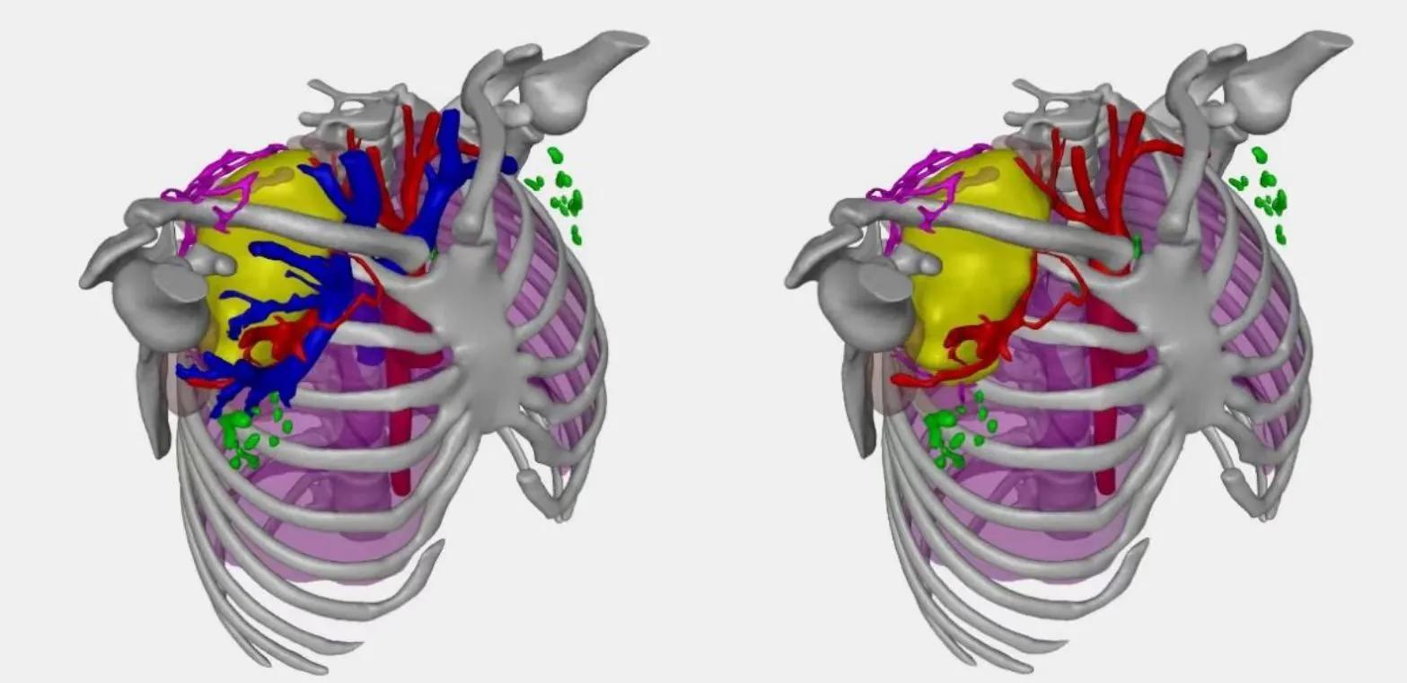 同济医院神经外科成功为患者摘除巨大臂丛神经纤维瘤