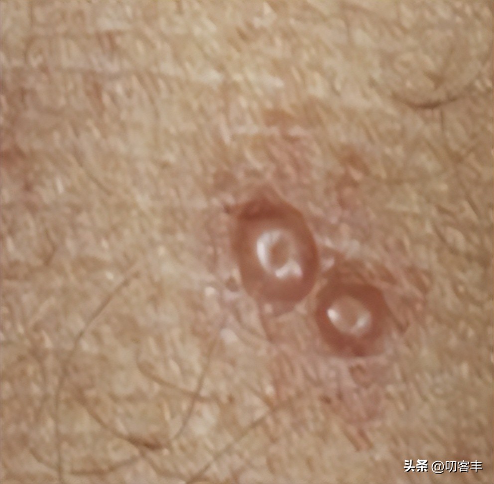 传染性软疣儿童怎么治,传染性软疣怎么好得最快