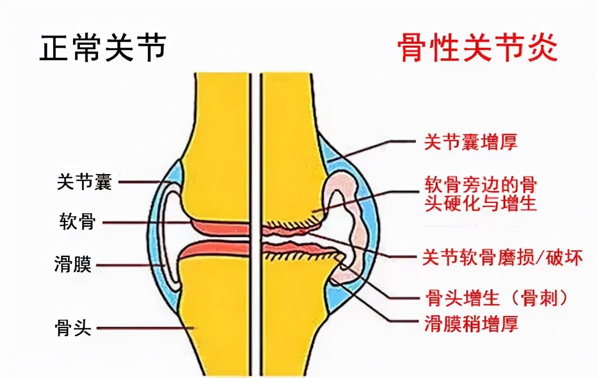 怎样才能确定是痛风性关节炎,关节疼如何区分是痛风还是风湿