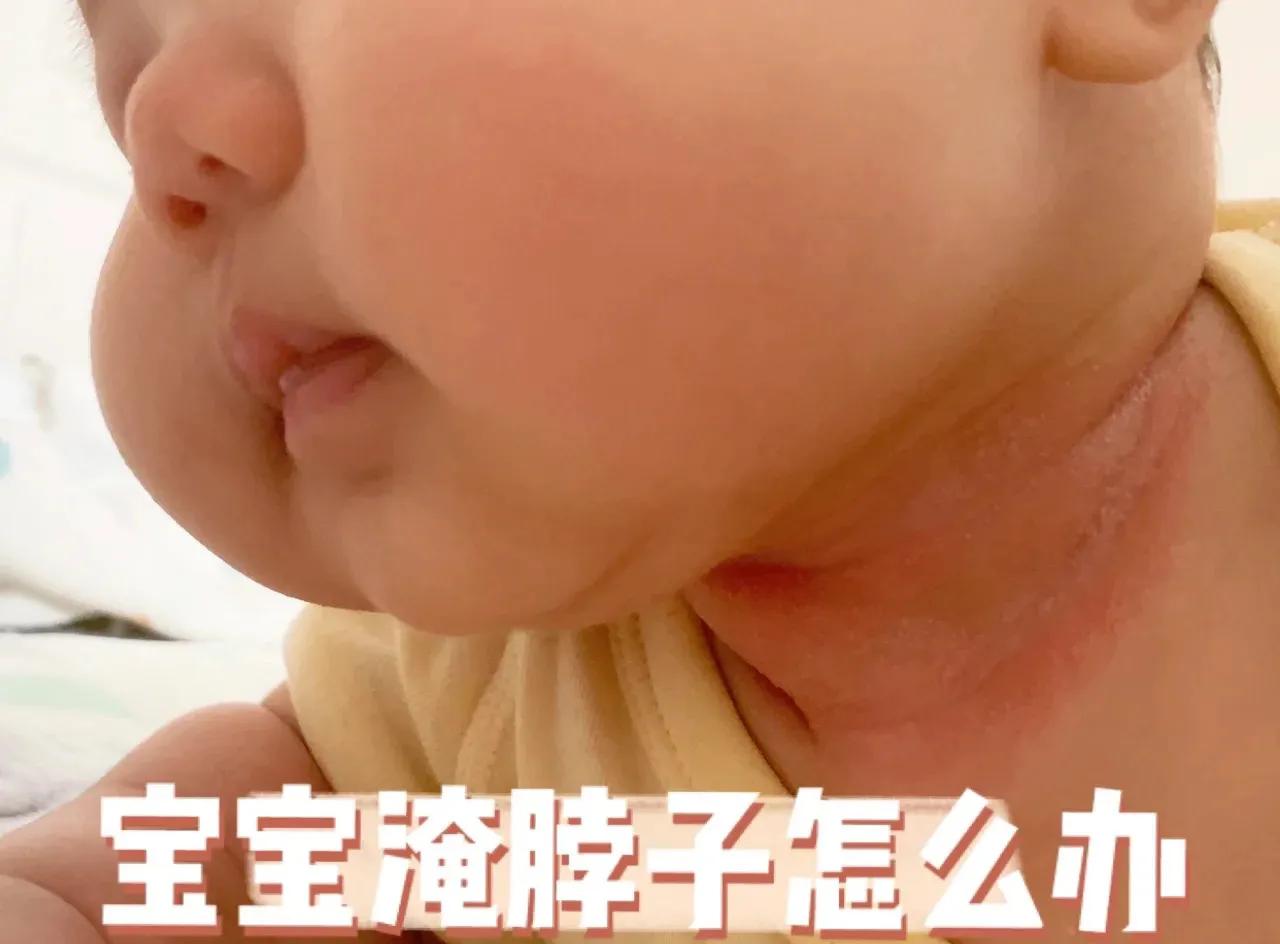 新生儿淹脖子发红怎么处理,宝宝淹脖子泛红涂什么最好