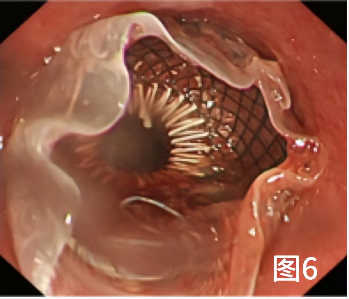病例档案纪录片,食管早期癌的内镜筛查