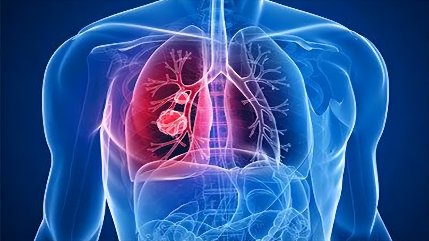 肩膀痛连着胳膊的肌肉痛是肺癌吗,肺癌晚期肩膀疼得厉害是怎么回事