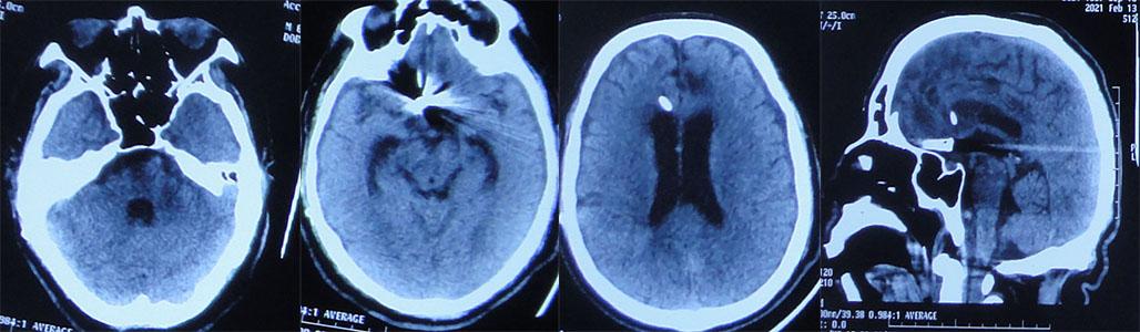 前交通动脉瘤破裂后开颅治疗风险,脑前交通动脉瘤破裂出血