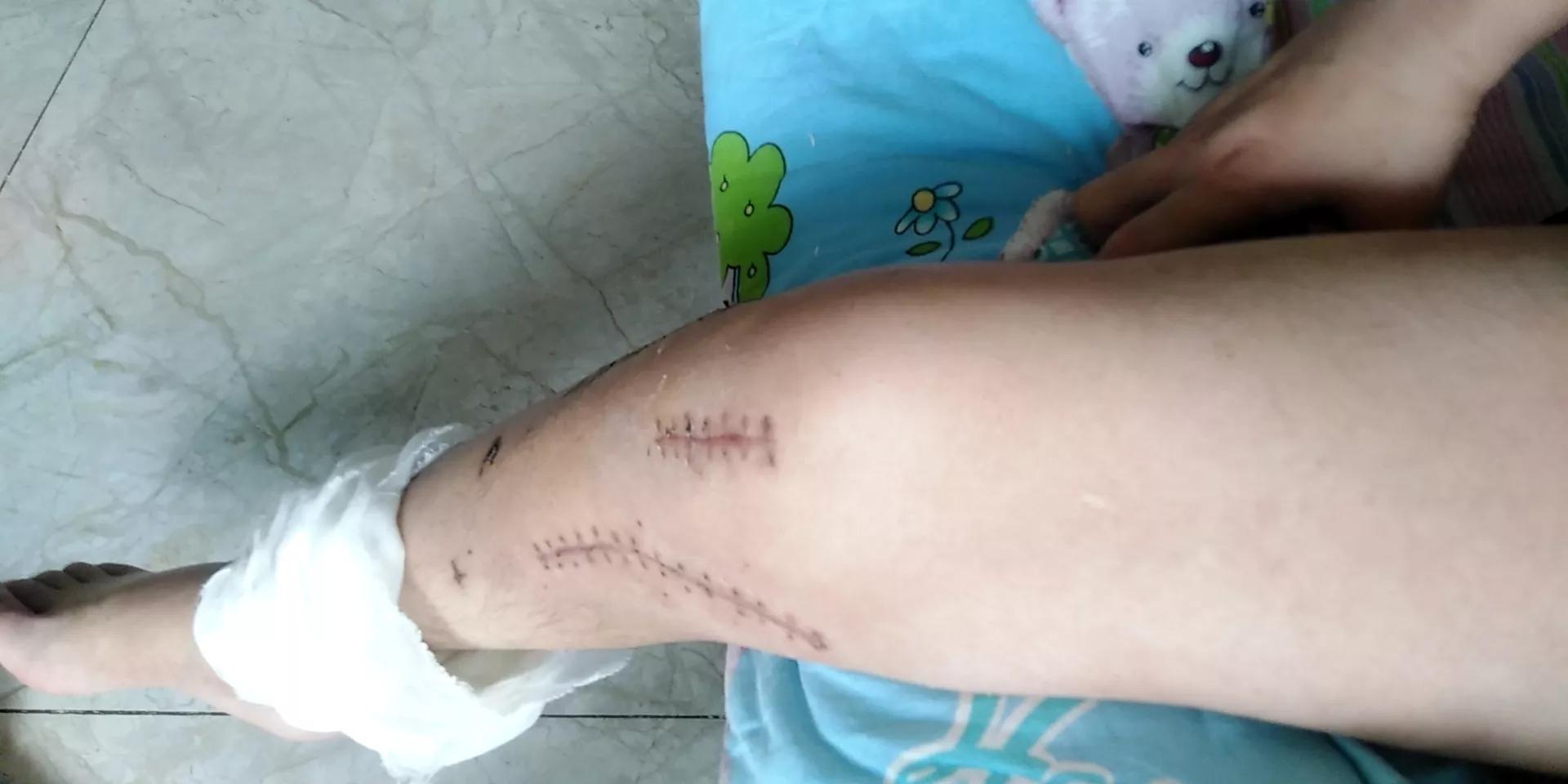 拆了石膏要怎么按摩康复,手掌拆石膏后如何康复训练