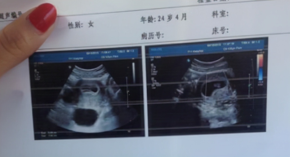 医生说有个囊肿是怎么回事,医生处理囊肿