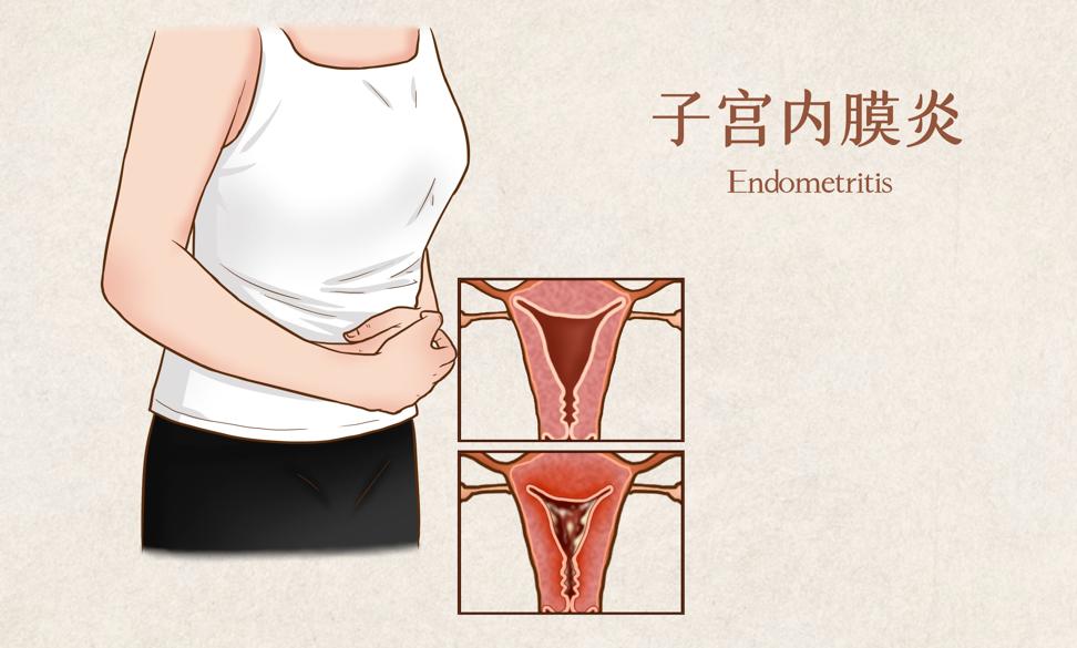 子宫内膜增厚的原因中医,中医能治疗子宫内膜厚吗