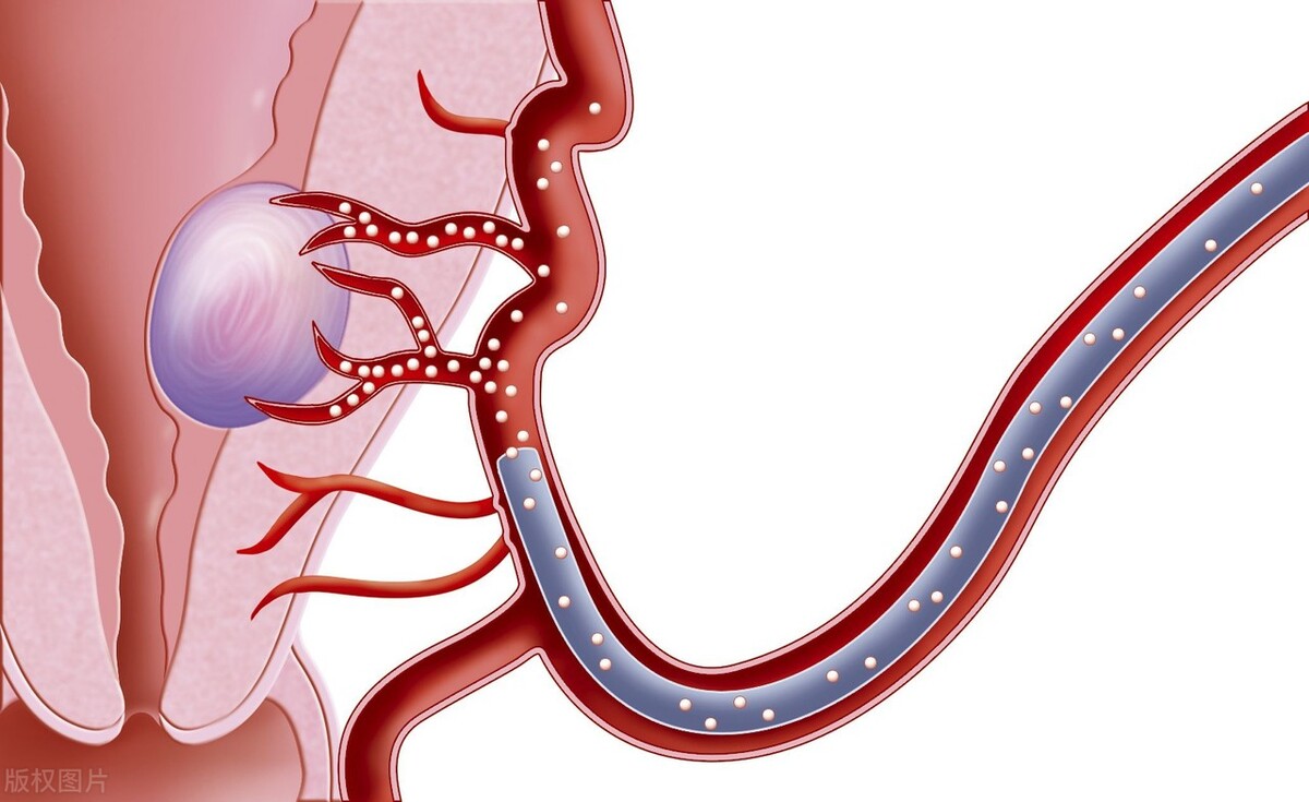 女性切除子宫会对男性有影响吗,女性全切除子宫对夫妻有影响吗