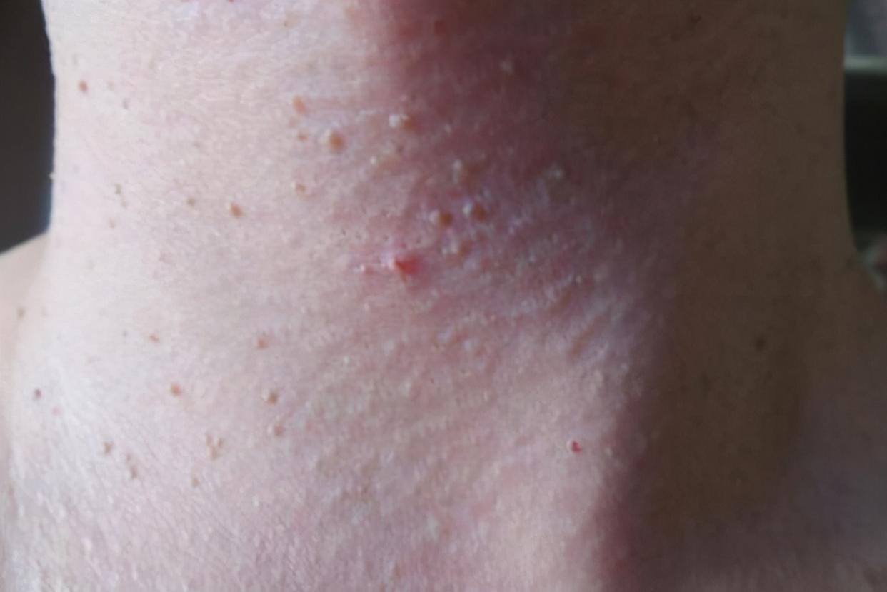 脖子上和腋下的小肉粒用什么药膏,如何让脖子上的小肉粒自然脱落